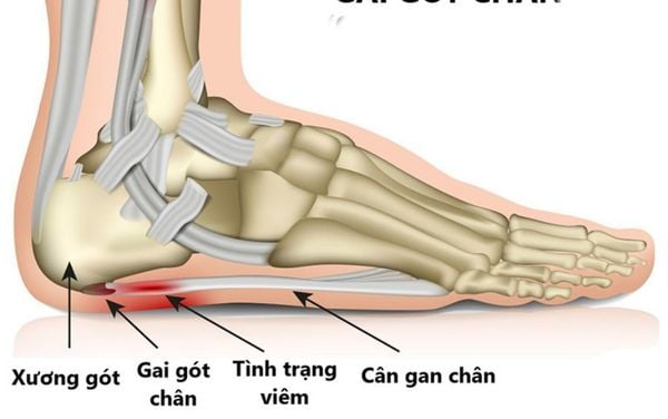 Đau gót chân