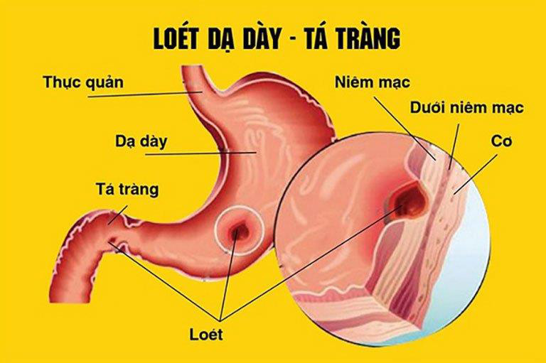 Cùng Thiên Ý Pharma tìm hiểu bệnh tiêu hóa phổ biến trong thời hiện đại - Ảnh 2.