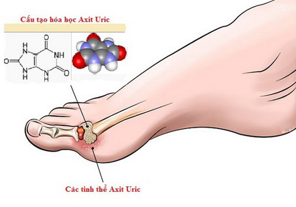 Bệnh Gout hoặc là bệnh Gút ( từ gút bắt nguồn từ tiếng Pháp goutte /ɡut/), còn gọi là thống phong, một loại viêm khớp, do rối loạn chuyển hóa nhân purin trong thận, khiến thận không thể lọc axit uric từ trong máu thường gặp ở nam giới.