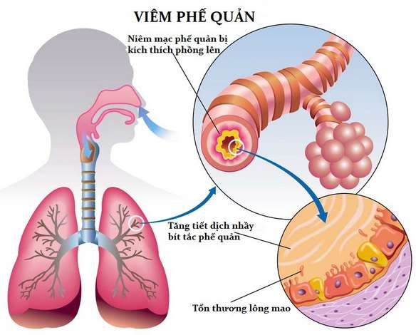 Triệu chứng đột quỵ ( tai biến mạch máu não) và các dấu hiệu có liên quan chẳng hạn như không còn khả năng đi đứng, di chuyển hoặc một nửa cơ thể không còn cảm giác, vấn đề nói cũng không rõ chữ nữa, chóng mặt hoặc mất thị lực sang một bên,... chúng thường xuất hiện ngay sau khi đột quỵ xảy ra.