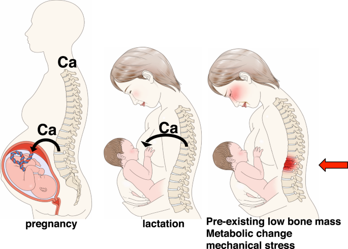 Dấu hiệu thiếu canxi ở bà bầu gây ra các triệu chứng làm mệt mỏi, các cơ bắp đau nhức, chuột rút dạng nhẹ, còn thai nhi có thể bị còi xương bẩm sinh, suy dinh dưỡng. Vì vậy, những dấu hiệu thiếu canxi ở bà bầu cần được phát hiện sớm để đi khám và bổ sung kịp thời đảm bảo sức khỏe của mẹ và bé.