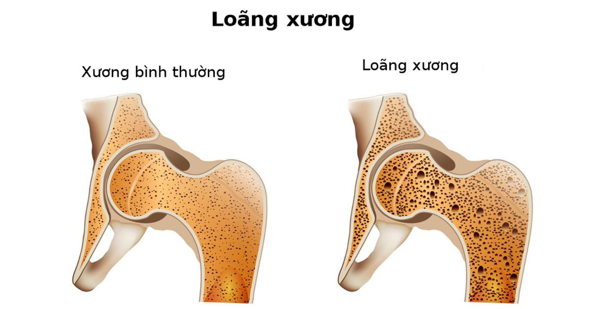 Giá đỗ (hay còn gọi là giá, giá đậu, củ giá hoặc quả giá) là hạt đậu xanh nảy mầm, dài chừng 3 đến 7 cm. Cách thông thường chúng ta làm là ủ cho nảy mầm từ hạt đậu xanh, một số loại khác từ mầm đậu tương hoặc đậu Hà Lan được đánh giá là bổ hơn.