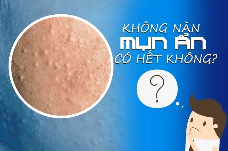 Mụn được xem là nỗi ám ảnh của tất cả mọi người dù là nam hay nữ, nhỏ hay lớn, già hay trẻ,....Tùy theo sức khỏe mỗi người mà chúng sẽ có kích thước lớn hay nhỏ, biến mất nhanh chóng hay có thể dai dẳng,...