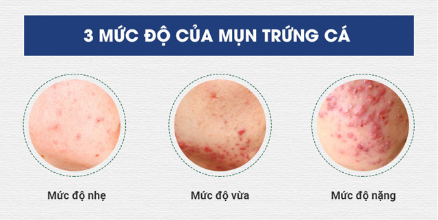 Mụn được xem là nỗi ám ảnh của tất cả mọi người dù là nam hay nữ, nhỏ hay lớn, già hay trẻ,....Tùy theo sức khỏe mỗi người mà chúng sẽ có kích thước lớn hay nhỏ, biến mất nhanh chóng hay có thể dai dẳng,...