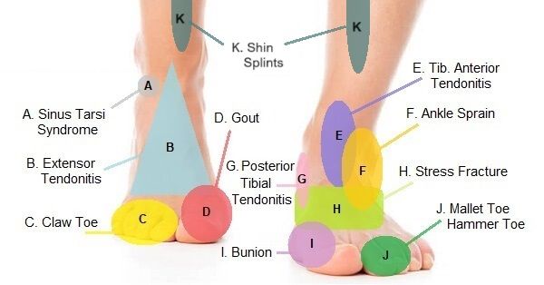 Sơ đồ đau phía trước bàn chân