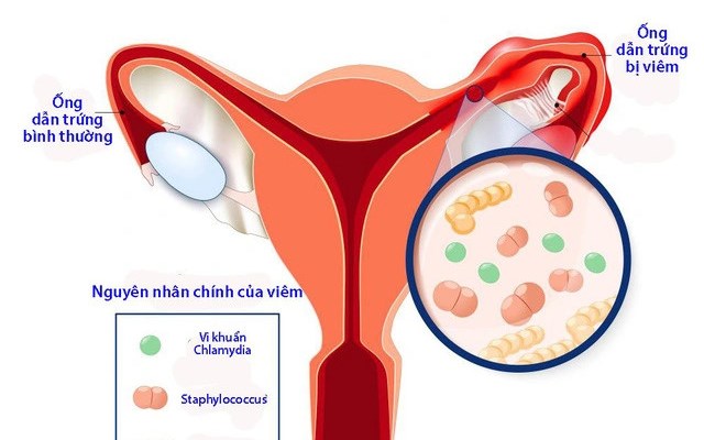 Bé 14 tuổi ở Hà Nội bất ngờ nhập viện vì viêm phần phụ cấp, bác sĩ cảnh báo nguyên nhân - Ảnh 2.